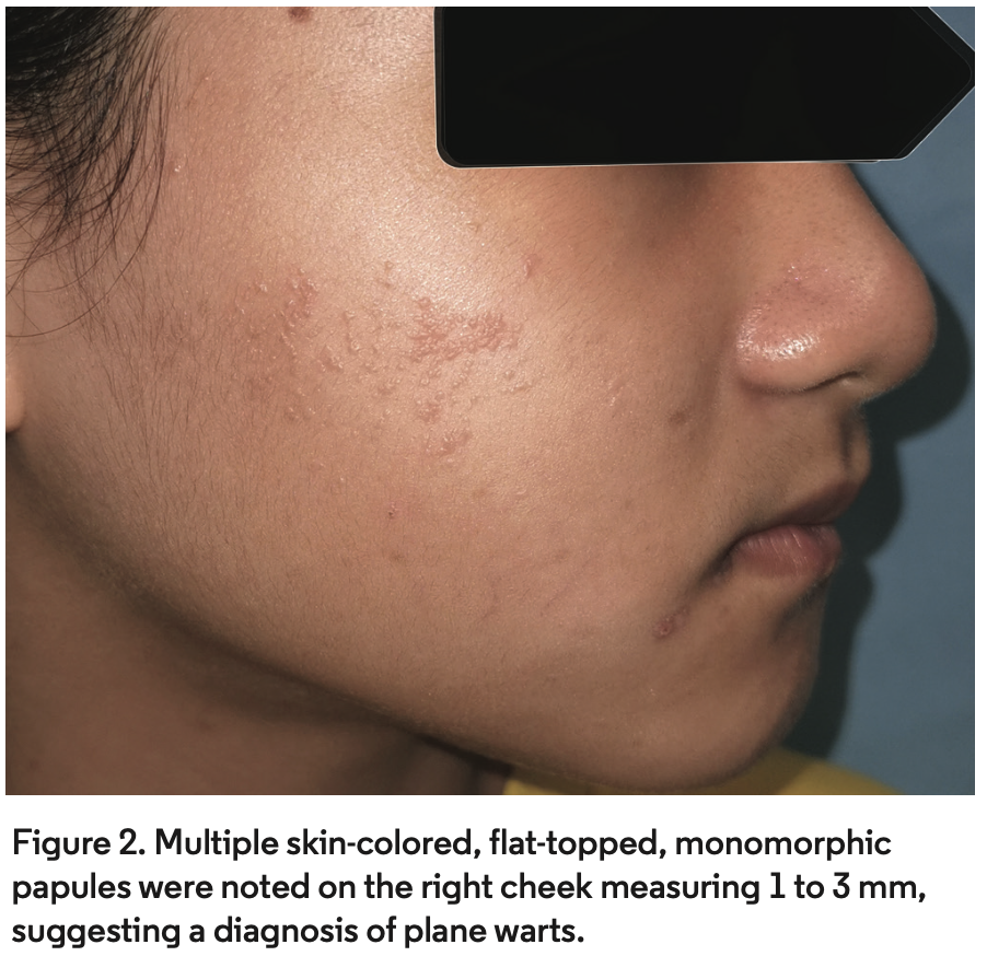 Pediatric Plane Warts Treated With Imiquimod